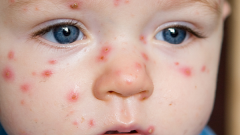Why adults suffer heavier chickenpox than children 