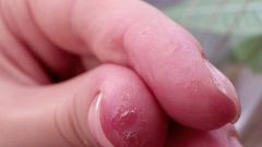 Why peel off the skin on the fingers and toes