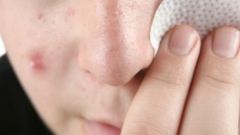 Mysterious rosacea - what is it and how to treat it 