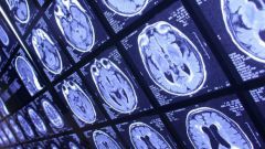 Нейрофизиологические причины ухудшения мышления при депрессии, СДВ и ПМС