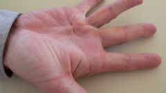 How to treat contracture of the palm