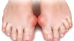 How to relieve the pain of gout
