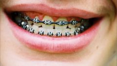 Whether to place braces at age 30 