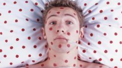 How to treat chickenpox in adult