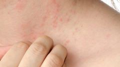 Мазь от аллергии на коже у взрослых: гормональные средства и другие препараты