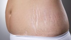 Как избавиться от растяжек, которые появляются на теле во время беременности