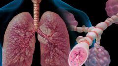 Бронхиальная астма: симптомы и лечение у взрослых