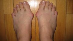 Лечение шишек на ногах у большого пальца без операции