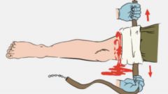 Кровоостанавливающий жгут: техника наложения 