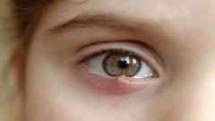 Как лечить ячмень на глазу у ребенка