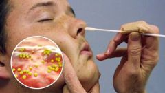 Как вылечить стафилококк в носу и во рту у взрослого