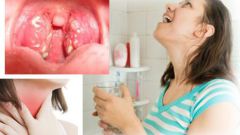 Как вылечить стафилококк в носу и во рту в домашних условиях