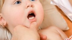 Как лечить молочницу во рту у ребенка в 2 месяца