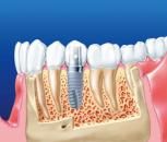 Имплантация зуба – новый зуб вместо потерянного