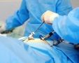 Операция лапароскопия – лучшая альтернатива полостной операции