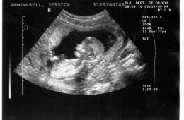 Фотография УЗИ при беременности
