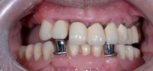 Сравнение длительного выживания имплантатов и эндодонтически леченых зубов