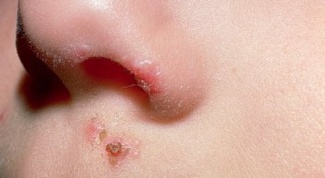 How to heal sores on face