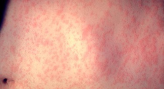 How to treat red rash