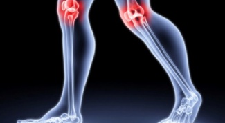 Как диагностировать артрит суставов