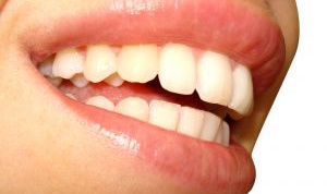 Как избавиться от желтизны зубов