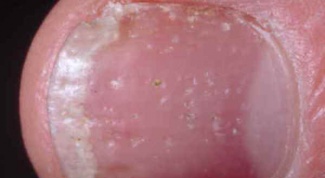How to treat nail psoriasis
