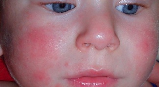 How to cure atopic dermatitis in child