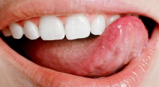 How to get rid of pimple on tongue