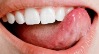 How to stop bleeding from the tongue