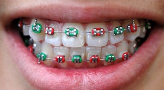 How much you need to wear braces