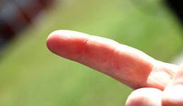 Как избавиться от занозы на пальце