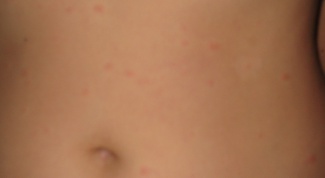 Itchy abdomen - what to do? Why the stomach small rash