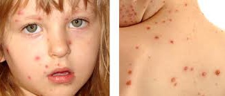 That allowed a child with chickenpox