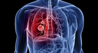 Первые симптомы рака легких