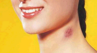 Home remedies for hickeys and bruises