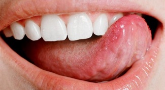 Sores under tongue: how to treat