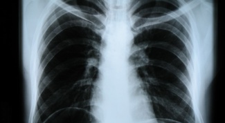 What is the radiation dose from x-rays