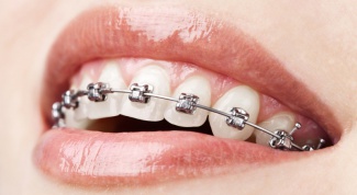 What is self-adjusting braces