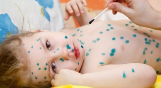 Complications of chickenpox in children 