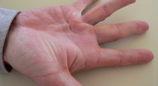 How to treat contracture of the palm