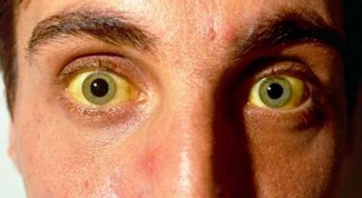 Почему желтеют белки глаз