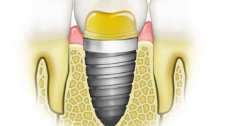 Как подобрать зубные импланты