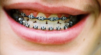 Whether to place braces at age 30 