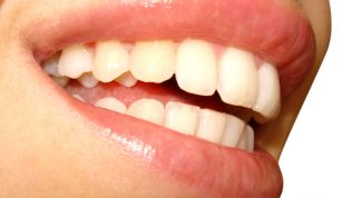Внутриканальное отбеливание зубов