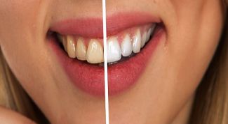 Можно ли чистить зубы содой пищевой для отбеливания