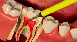 Должен ли болеть зуб после лечения каналов