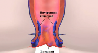 Внутренний геморрой: симптомы у женщин и мужчин