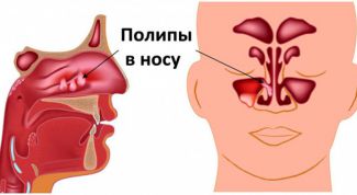 Полипы в носу: что это такое, симптомы, лечение, причины возникновения