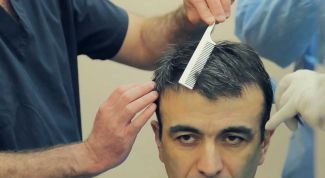  Методы пересадки волос: как обрести шикарную прическу