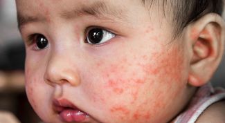 Как избавиться от атопического дерматита у ребенка